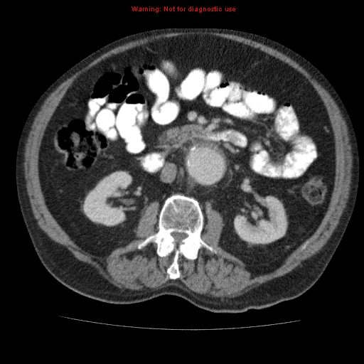 Abdominal aortic aneurysm (Radiopaedia 10122-10660 Axial C+ portal venous phase 34).jpg