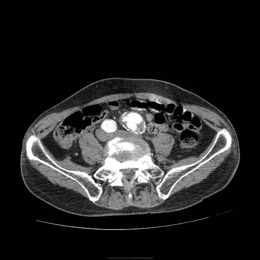 File:Abdominal aortic aneurysm (Radiopaedia 13341-13340 Axial C+ arterial phase 162).jpg