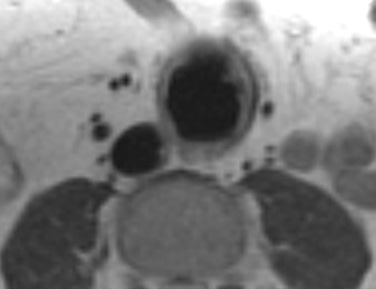 File:Abdominal aortic aneurysm (Radiopaedia 14317-14210 Axial Double IR FSE black blood sequence 1).jpg