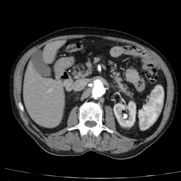 Abdominal aortic aneurysm (Radiopaedia 29248-29660 Axial C+ arterial phase 31).jpg