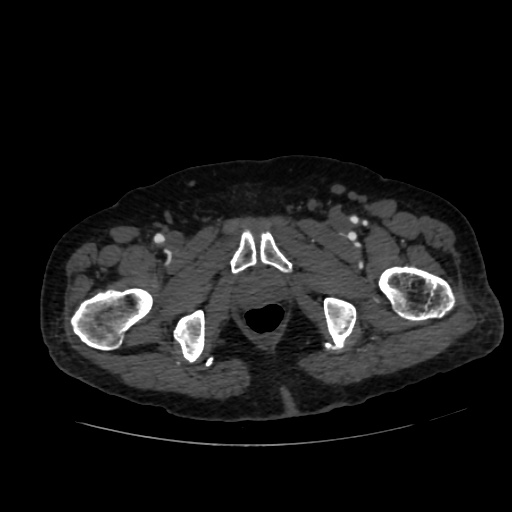 File:Abdominal aortic aneurysm (Radiopaedia 57318-64259 Axial C+ arterial phase 79).jpg