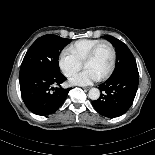 Abdominal aortic aneurysm (Radiopaedia 83581-98689 Axial C+ portal venous phase 1).jpg