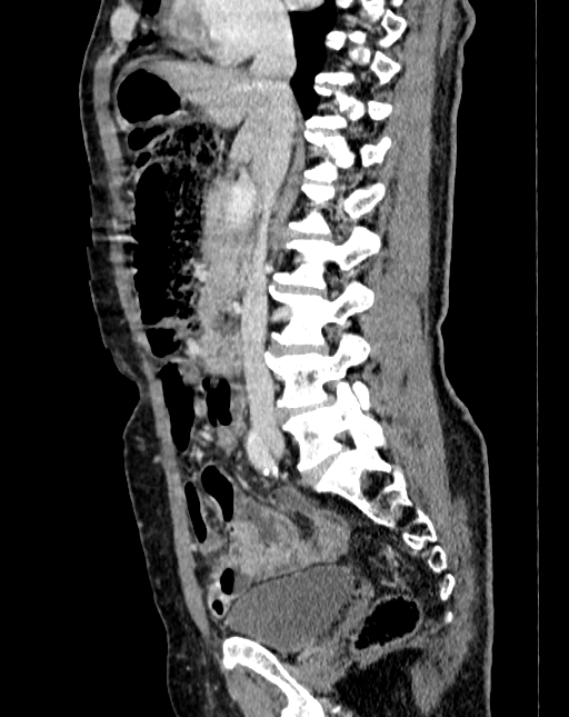 Abdominal aortic aneurysm (Radiopaedia 83581-98689 Sagittal C+ portal venous phase 35).jpg