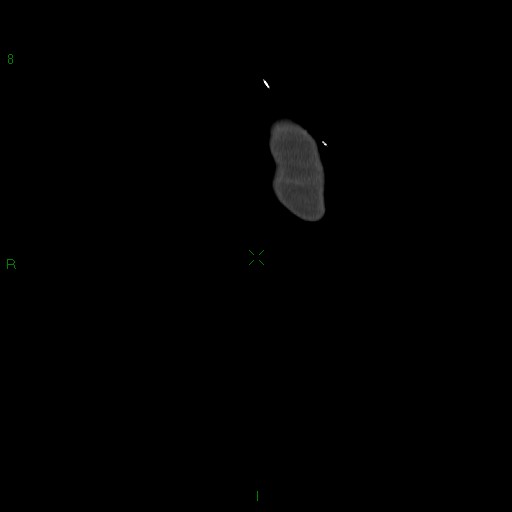 File:Abdominal aortic aneurysm rupture with aortocaval fistula (Radiopaedia 14897-14841 Coronal C+ arterial phase 8).jpg