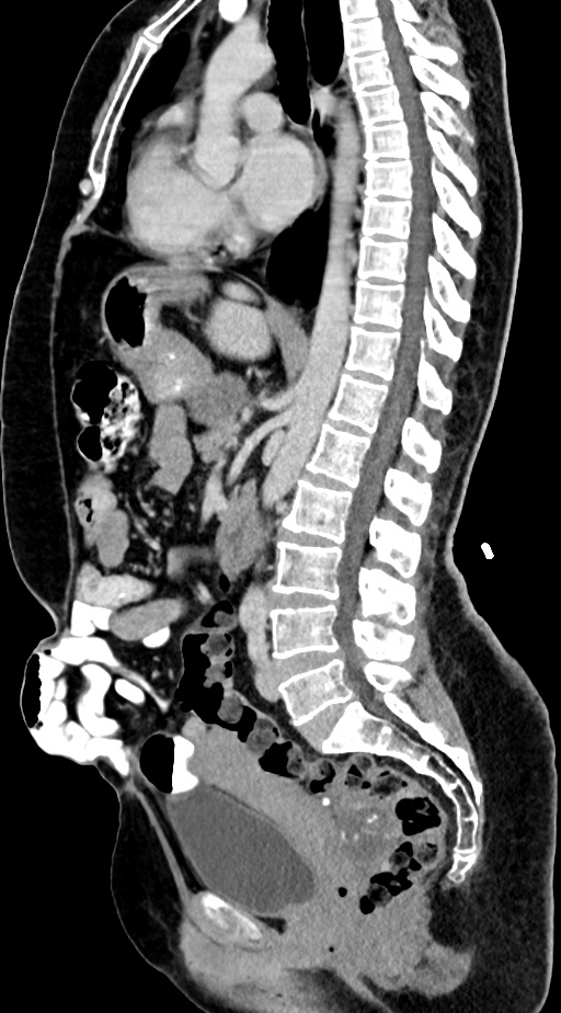 Abdominal hydatid disease (Radiopaedia 68223-77737 Sagittal C+ portal venous phase 35).jpg