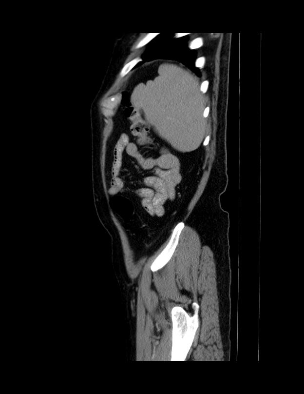 Abdominal lymphoma - with sandwich sign (Radiopaedia 53486-59492 Sagittal C+ portal venous phase 9).jpg