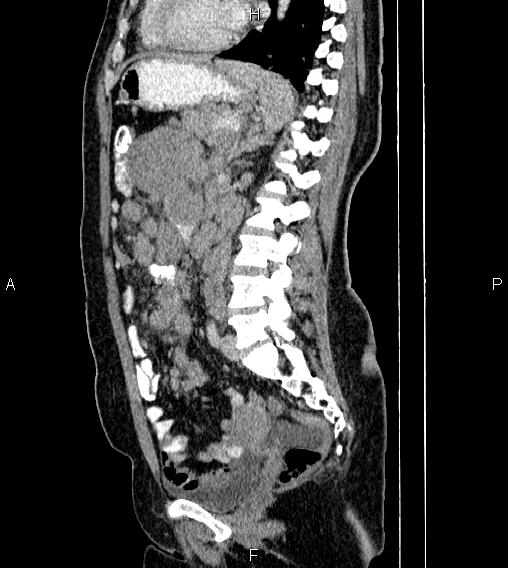 Abdominal lymphoma with sandwich sign (Radiopaedia 84378-99704 Sagittal C+ portal venous phase 54).jpg