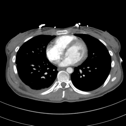 File:Abdominal multi-trauma - devascularised kidney and liver, spleen and pancreatic lacerations (Radiopaedia 34984-36486 Axial C+ arterial phase 54).png