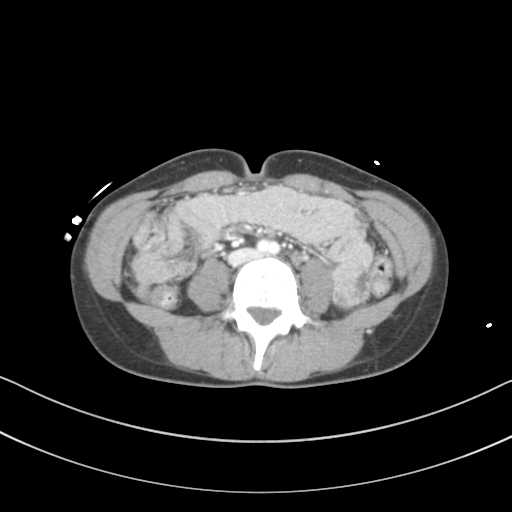 File:Abdominal multi-trauma - devascularised kidney and liver, spleen and pancreatic lacerations (Radiopaedia 34984-36486 Axial C+ portal venous phase 48).png