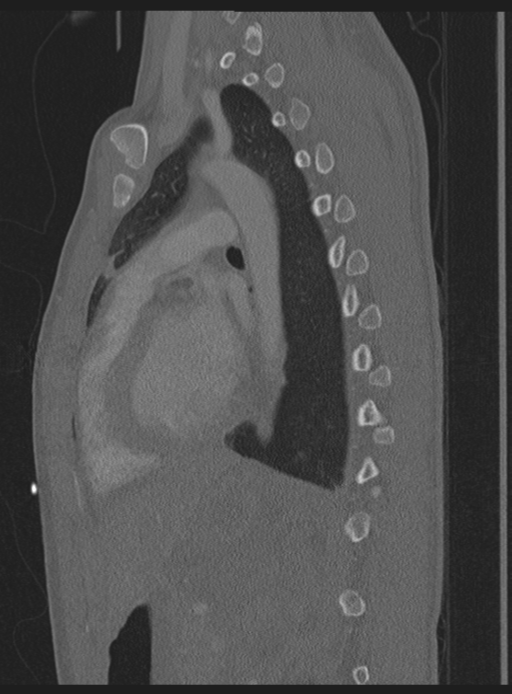 Abdominal multi-trauma - devascularised kidney and liver, spleen and pancreatic lacerations (Radiopaedia 34984-36486 Sagittal bone window 18).png