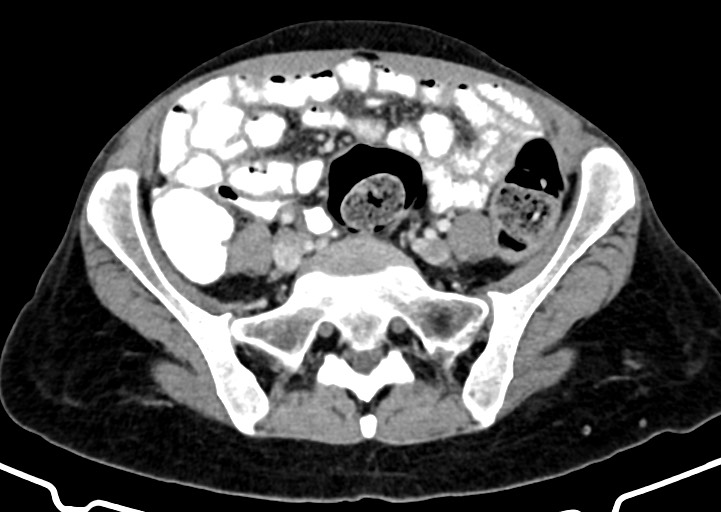 Abdominal wall and retroperitoneal tuberculosis (Radiopaedia 88137-104729 Axial C+ portal venous phase 133).jpg