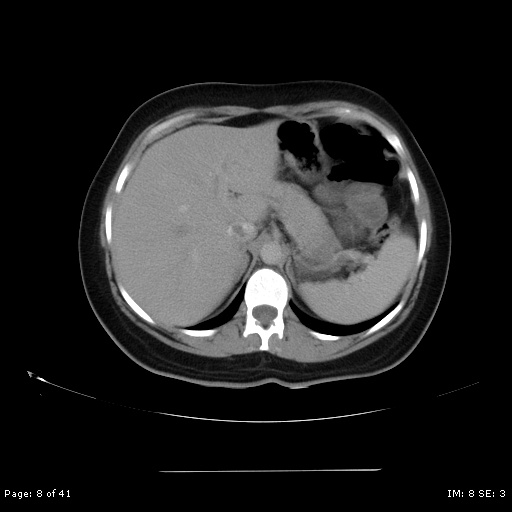 File:Abdominal wall endometriosis (Radiopaedia 25723-25885 Axial C+ portal venous phase 8).jpg