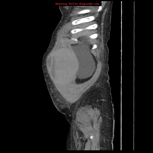 File:Abdominal wall hematoma (Radiopaedia 9427-10112 Sagittal C+ portal venous phase 99).jpg