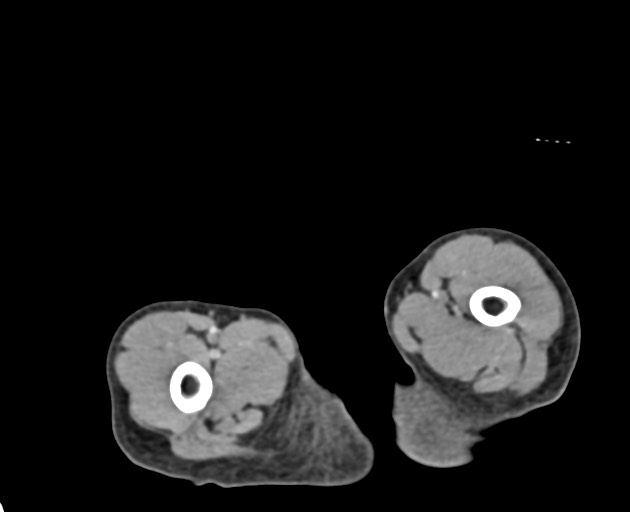 File:Abdominopelvic rhabdomyosarcoma (Radiopaedia 78356-90984 Axial C+ portal venous phase 174).jpg