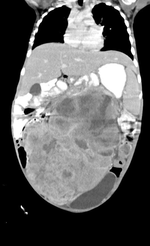 Abdominopelvic rhabdomyosarcoma (Radiopaedia 78356-90984 Coronal C+ portal venous phase 38).jpg