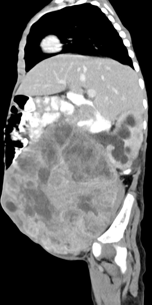 Abdominopelvic rhabdomyosarcoma (Radiopaedia 78356-90984 Sagittal C+ portal venous phase 64).jpg