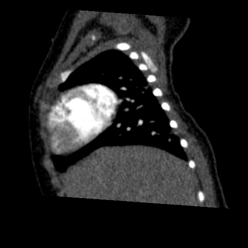 Aberrant left pulmonary artery (pulmonary sling) (Radiopaedia 42323-45435 Sagittal C+ arterial phase 12).jpg