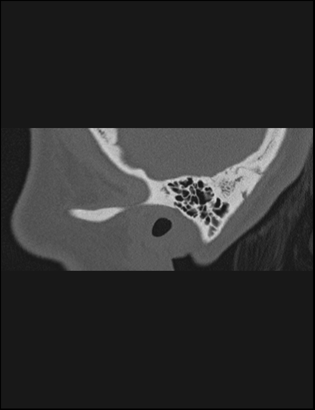 Aberrant right internal carotid artery (Radiopaedia 65191-74198 Sagittal non-contrast 14).jpg