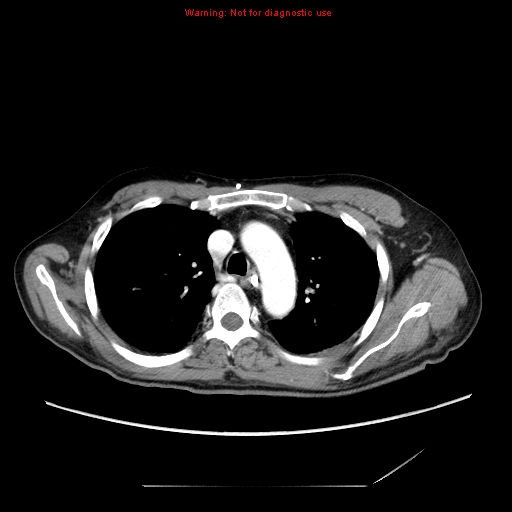 File:Aberrant right subclavian artery (Radiopaedia 9379-10071 Axial C+ arterial phase 21).jpg