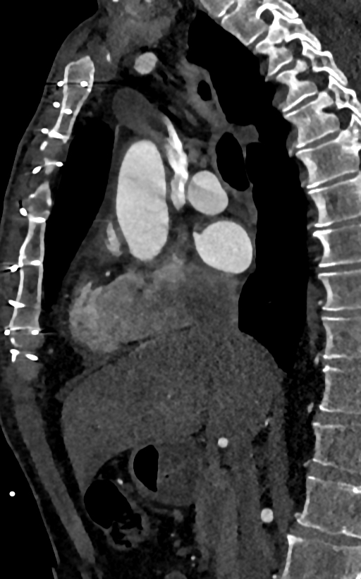 Accessory left atrial appendage (Radiopaedia 81987-95968 Sagittal C+ arterial phase 26).jpg