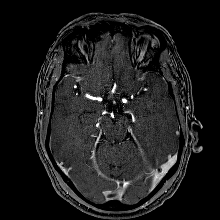 Accessory middle cerebral artery (Radiopaedia 73114-83828 Axial MRA 70).jpg