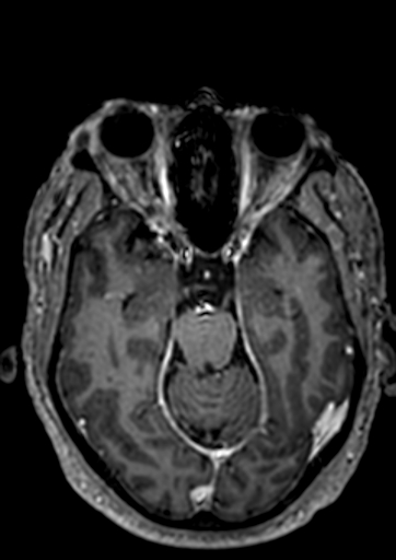 Accessory middle cerebral artery (Radiopaedia 73114-83828 Axial T1 C+ 87).jpg