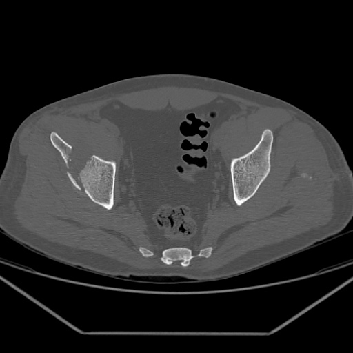 Acetabular and ilial fractures (Radiopaedia 59084-66378 Axial bone window 35).jpg