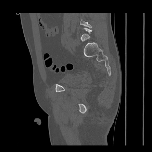 Acetabular and ilial fractures (Radiopaedia 59084-66378 Sagittal bone window 62).jpg