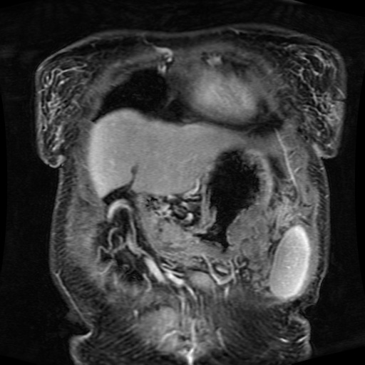 Acinar cell carcinoma of the pancreas (Radiopaedia 75442-86668 Coronal T1 C+ fat sat 155).jpg