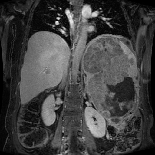 Acinar cell carcinoma of the pancreas (Radiopaedia 75442-86668 Coronal T1 C+ fat sat 79).jpg