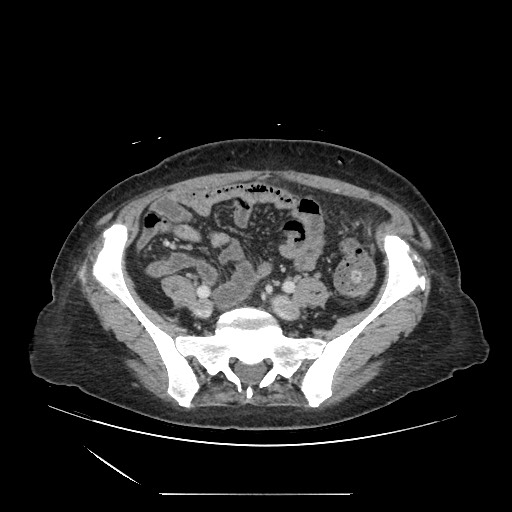 File:Acinar cell carcinoma of the pancreas (Radiopaedia 75442-86669 Axial C+ portal venous phase 106).jpg