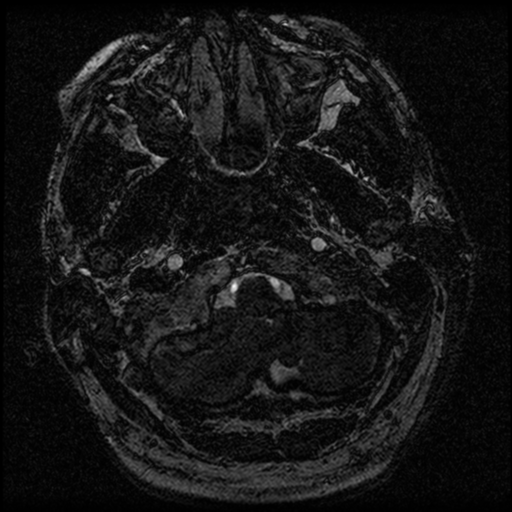 File:Acoustic schwannoma (Radiopaedia 39170-41387 Axial FIESTA 11).png