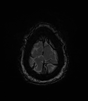 Acoustic schwannoma (Radiopaedia 50846-56358 Axial SWI 87).png
