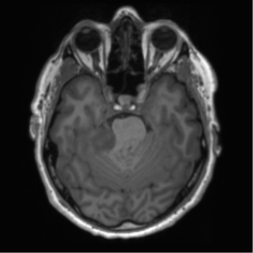 File:Acoustic schwannoma (Radiopaedia 50846-56358 Axial T1 33).png