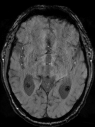 Acoustic schwannoma (Radiopaedia 55729-62281 Axial SWI 24).png