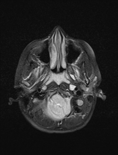 File:Acquired cerebellar tonsillar ectopia (Radiopaedia 39950-42423 Axial FLAIR 3).jpg