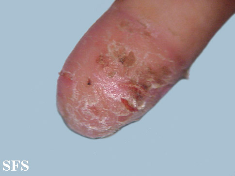 File:Acrodermatitis Continua (Dermatology Atlas 4).jpg