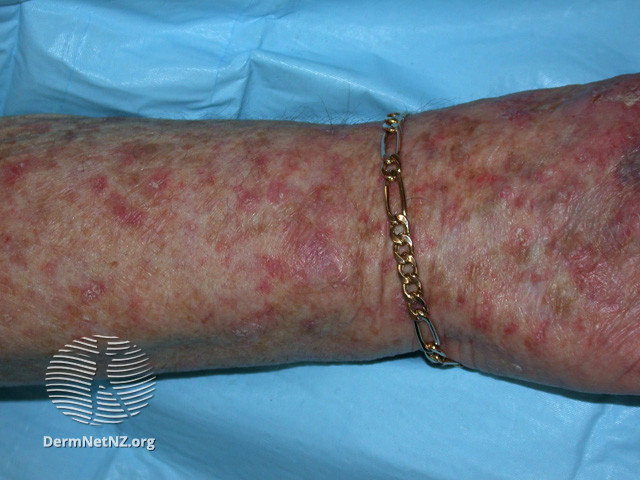 File:Actinic keratoses affecting the hands (DermNet NZ lesions-ak-hands-568).jpg