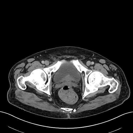 Active lower gastrointestinal bleeding - diverticular (Radiopaedia 61203-69106 Axial C+ portal venous phase 123).jpg