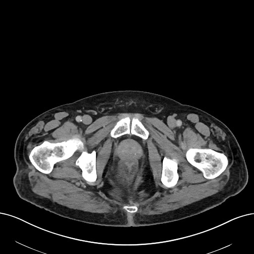 File:Active lower gastrointestinal bleeding - diverticular (Radiopaedia 61203-69106 Axial C+ portal venous phase 130).jpg