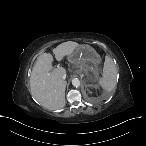 File:Active renal extravasation with large subcapsular and retroperitoneal hemorrhage (Radiopaedia 60975-68796 Axial 309).jpg