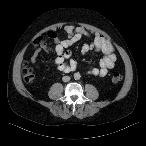 File:Acute-on-chronic pancreatitis (Radiopaedia 67286-76656 Axial C+ portal venous phase 46).jpg