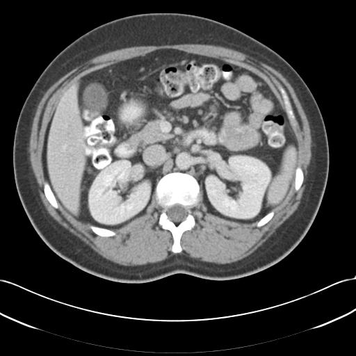 Acute appendicitis (Radiopaedia 30297-30934 Axial C+ portal venous phase 29).jpg