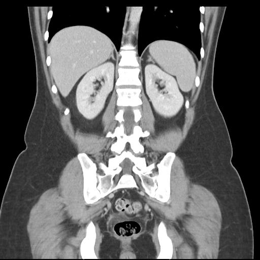 Acute appendicitis (Radiopaedia 30297-30934 Coronal C+ portal venous phase 33).jpg