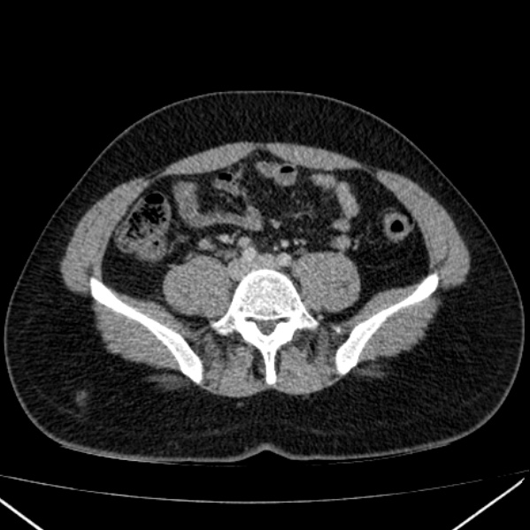 File:Acute appendicitis (Radiopaedia 38255-40270 Axial C+ portal venous phase 71).jpg