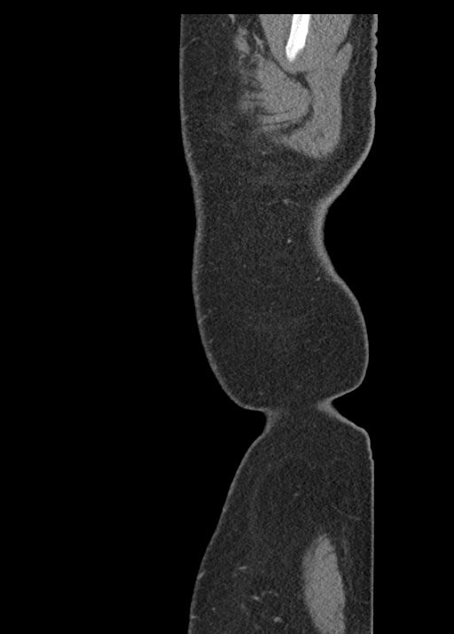 Acute appendicitis (Radiopaedia 48511-53463 Sagittal C+ portal venous phase 11).jpg
