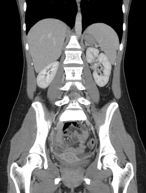 Acute appendicitis (Radiopaedia 62608-70901 Coronal C+ portal venous phase 33).jpg