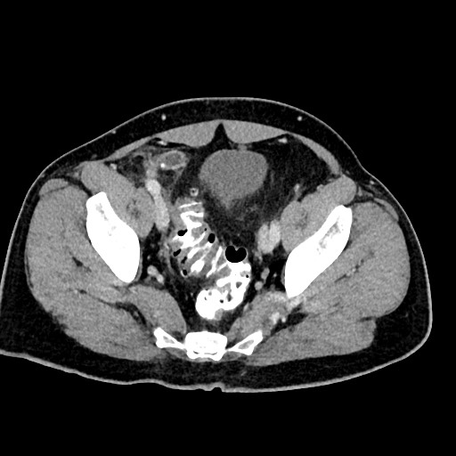Acute appendicitis (Radiopaedia 77016-88960 Axial C+ portal venous phase 121).jpg