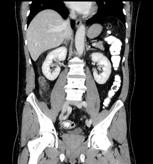 Acute appendicitis (Radiopaedia 77016-88960 Coronal C+ portal venous phase 58).jpg