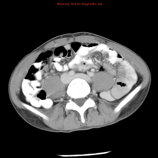 Acute appendicitis (Radiopaedia 8195-9045 Axial C+ portal venous phase 47).jpg